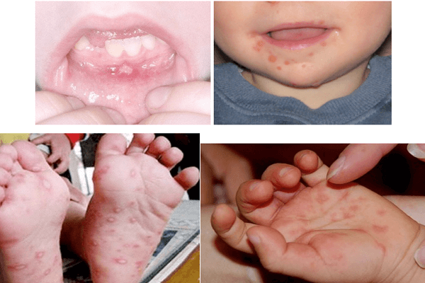 KidsOnline-bệnh chân tay miệng ở trẻ em 1