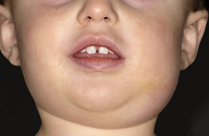 kidsonline-Bệnh quai bị ở trẻ em (P1): Nguyên nhân và triệu chứng bệnh quai bị1